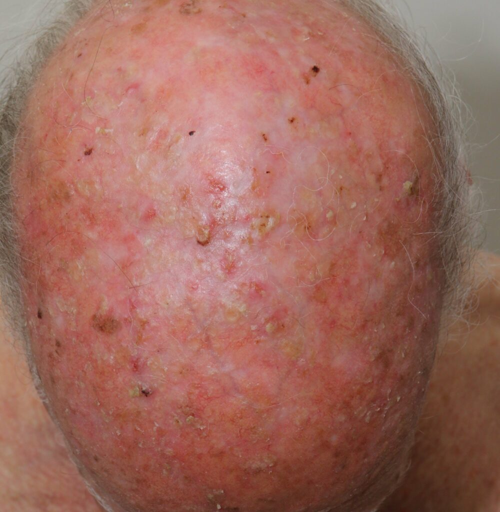 | Skintel Photo of actinic field damage on the scalp.