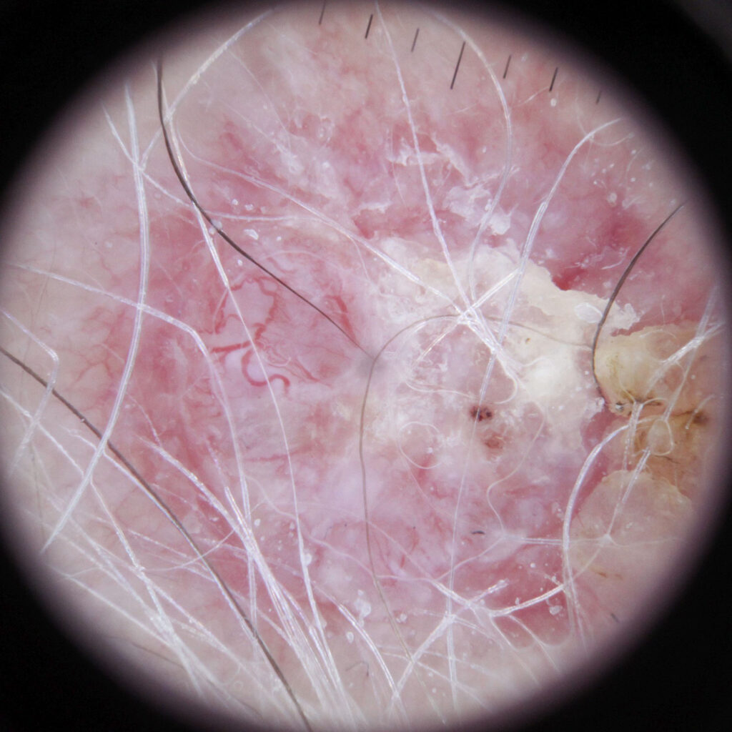 Mohs-TFI | Skintel Dermoscopy of basal cell carcinoma (BCC)
