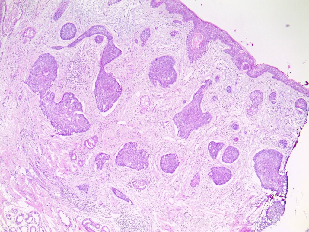 | Skintel Histology of nodular basal cell carcinoma (BCC)