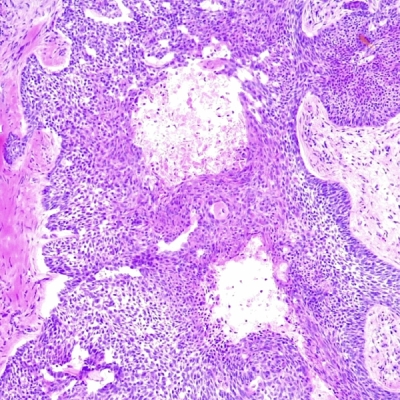 | Skintel Histology of nodular basal cell carcinoma (BCC) at 10x magnifcation