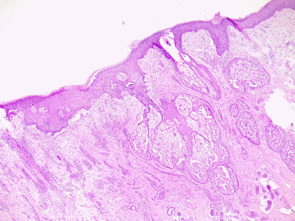 MelanomaDermoscopy02 | Skintel Histology of superficial basal cell carcinoma (BCC)