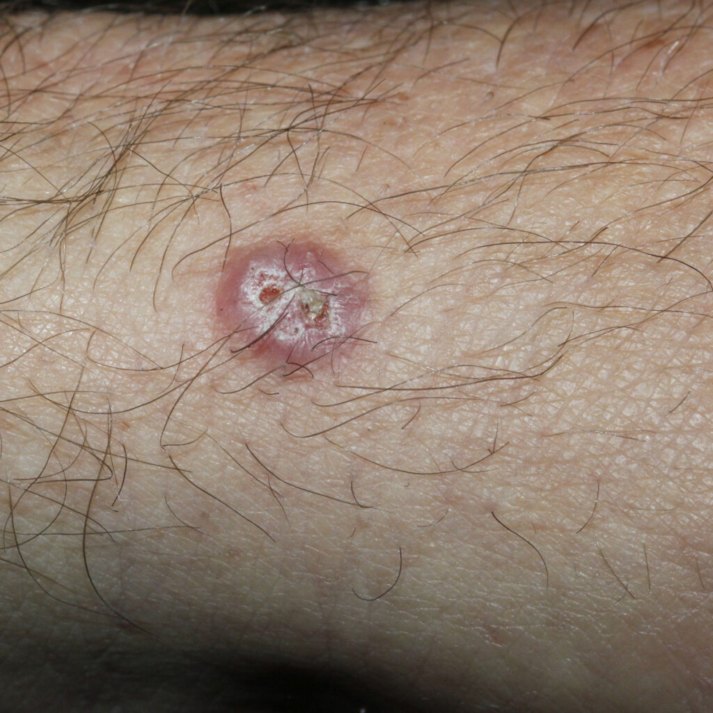 ShaveIllus | Skintel Clinical photo of a missed basal cell carcinoma (BCC) on the arm