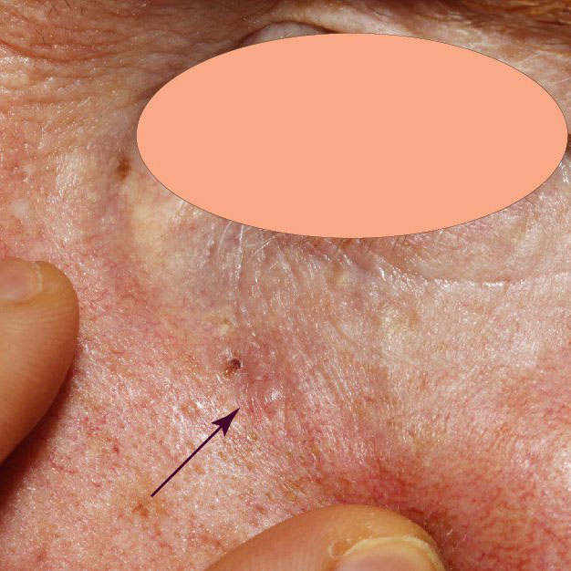 SCCisIllus | Skintel Clinical photo of a missed basal cell carcinoma (BCC) on the cheek