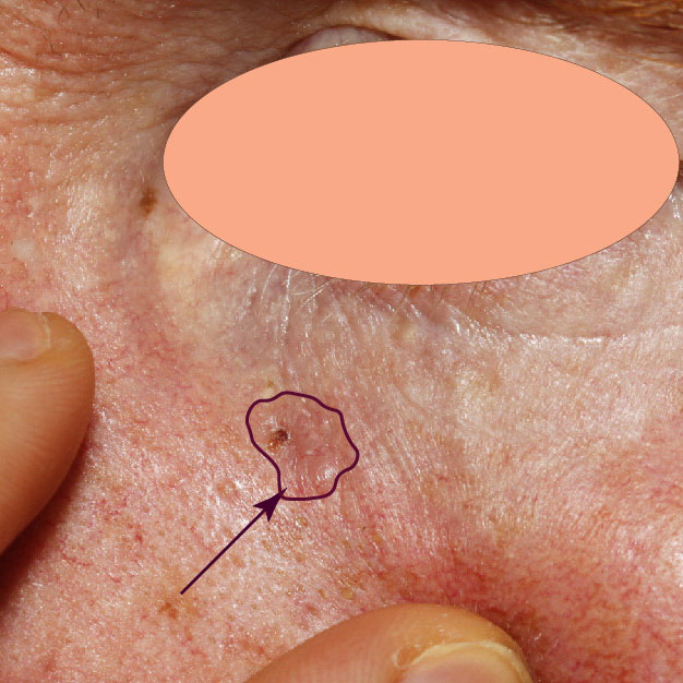 sunscreenBack | Skintel Clinical photo of a subtle basal cell carcinoma (BCC) skin cancer on the cheek with a marked border.