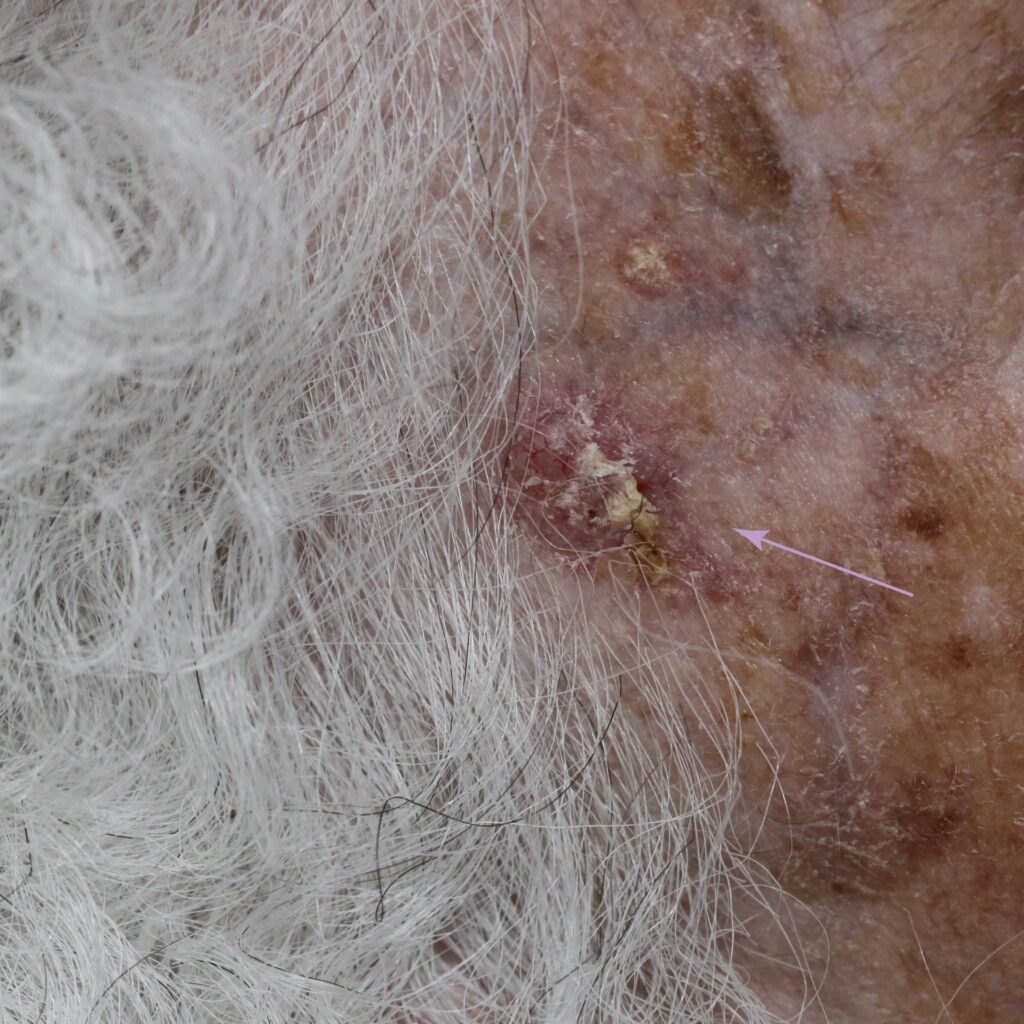 ShaveThree | Skintel Clinical photo of basal cell carcinoma (BCC) on the temple