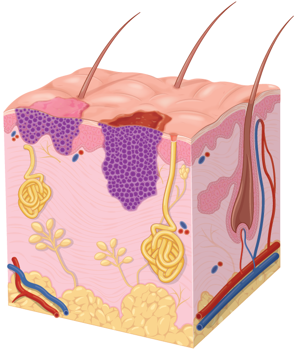 Electrocoagulation | Skintel Diagram comparing basal cell carcinomas (BCCS) - superficial and nodular