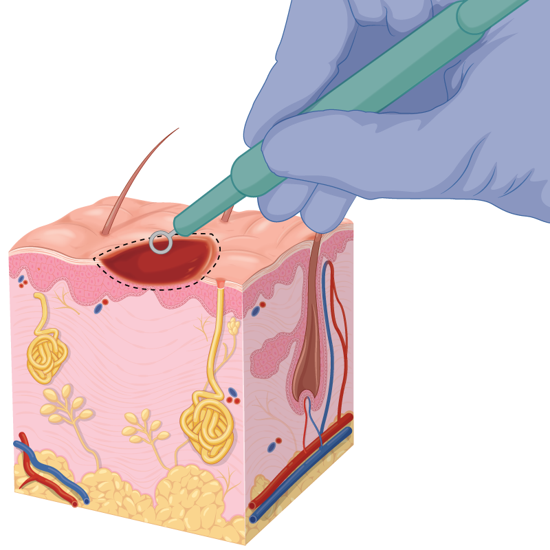 NormalSkin | Skintel Diagram of curettage