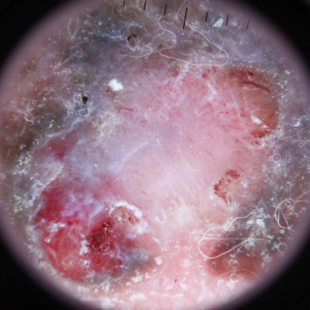 | Skintel Photo of melanoma dermoscopy