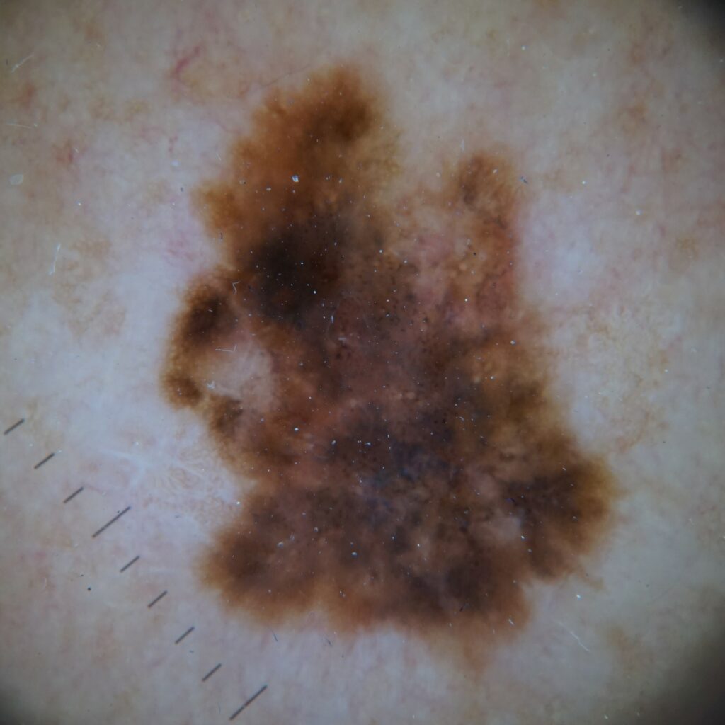 SonicHedgehogPathway | Skintel Photo of melanoma dermoscopy