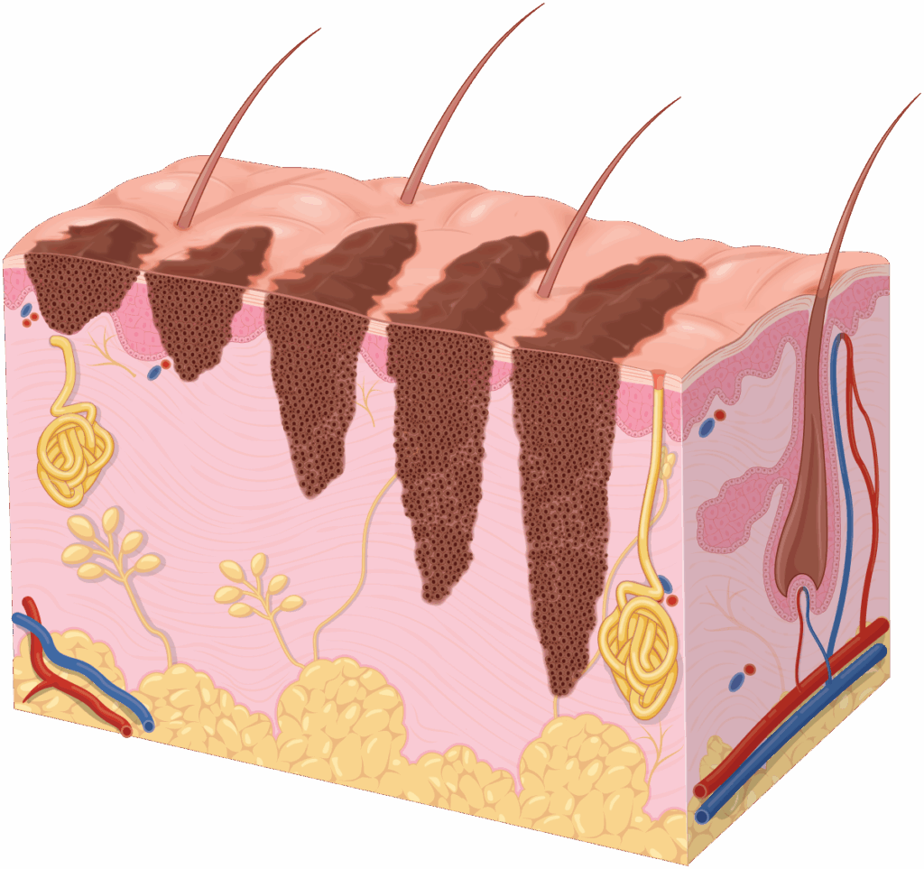 MohsSurgery-feat | Skintel Diagram of different melanoma depths