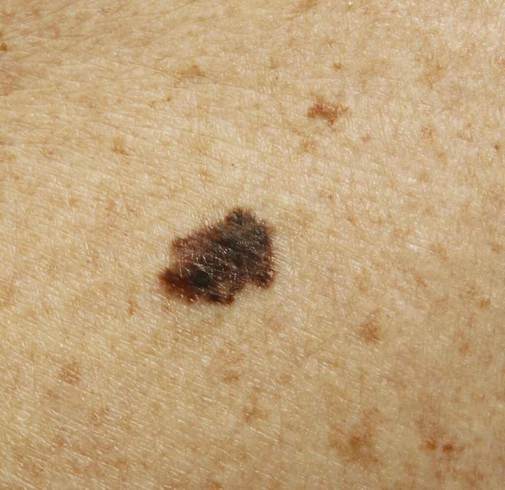 SPF1000 | Skintel Clinical photo of melanoma