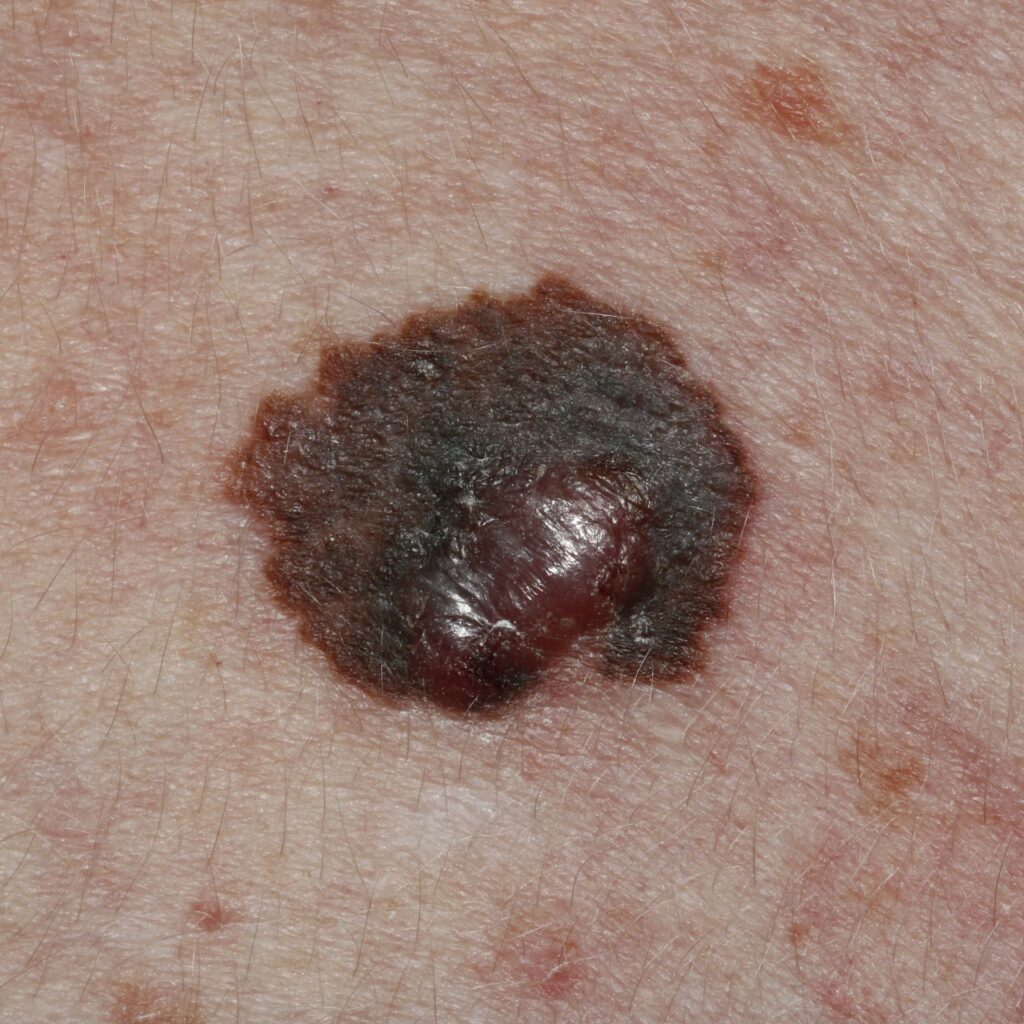 BCCSubtle-marked | Skintel Clinical photo of melanoma