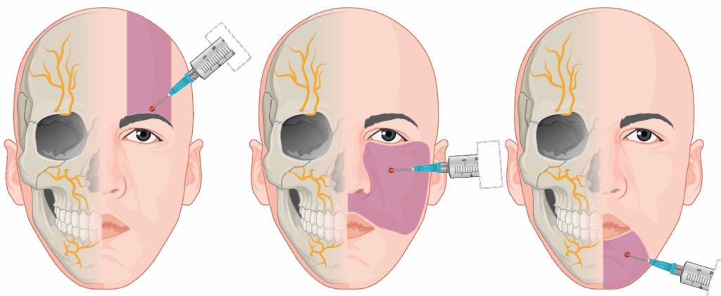 TumourCategory | Skintel Diagram of different nerve block techniques on face
