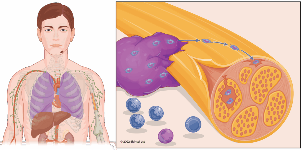 Bandaid | Skintel Diagram of perineural invasion from skin cancer