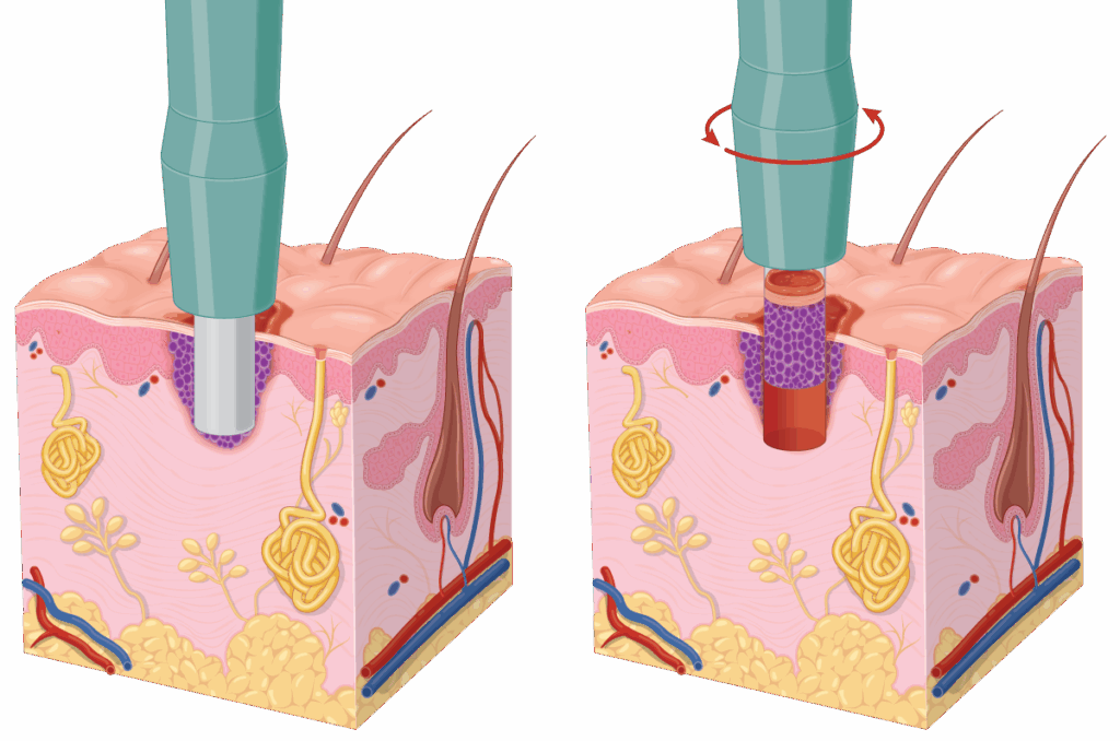 | Skintel Illustration of punch biopsy before and after.