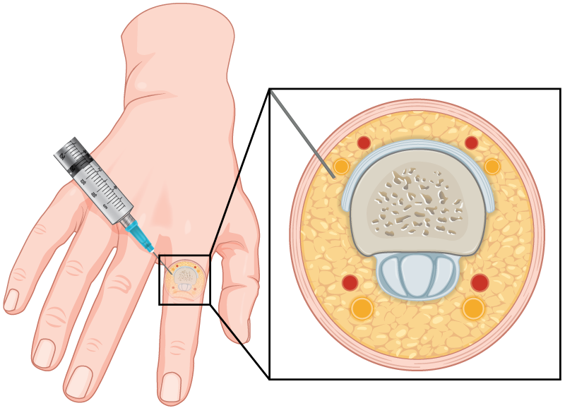 southernCross | Skintel Diagram of local anaesthetic ring block of finger