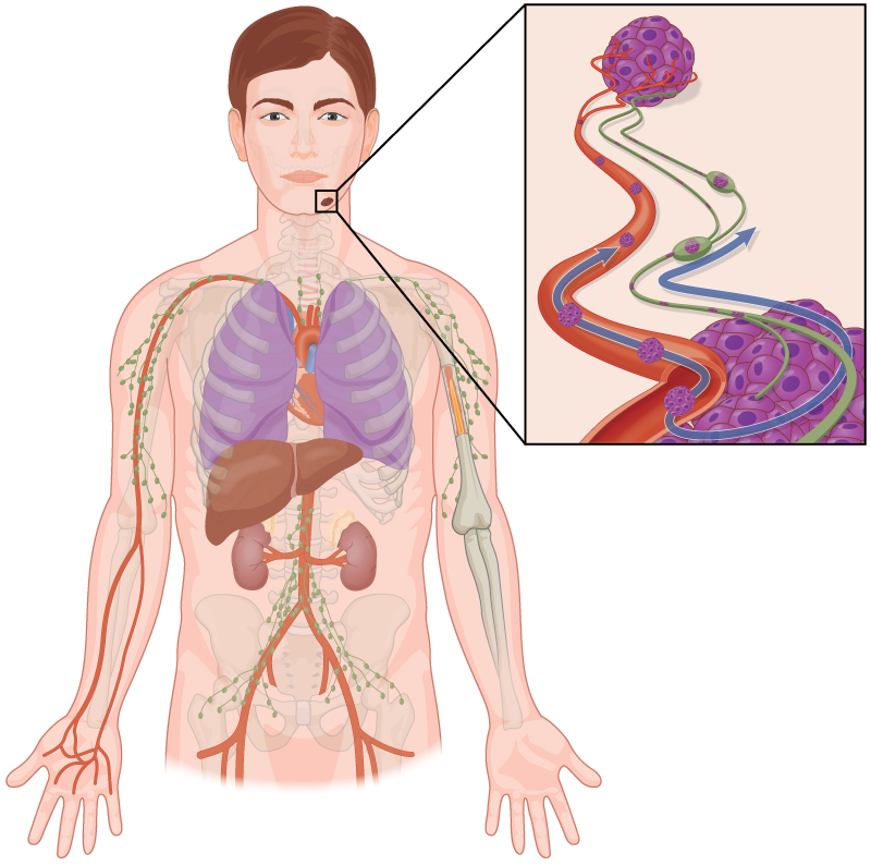 | Skintel Diagram of skin cancer metastatic spread