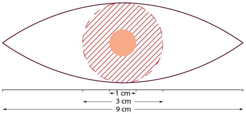 scalpelCtn | Skintel Diagram of 10 mm surgical margins
