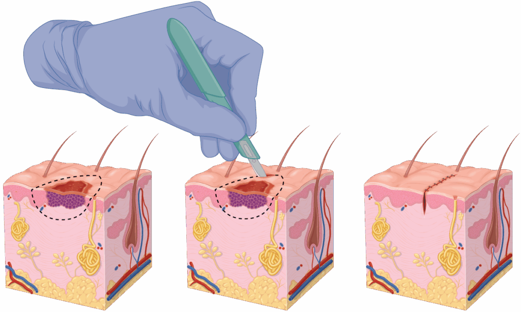 AcademyHat-sq | Skintel Wide Local Excision Illustration. Skin cancer removal.