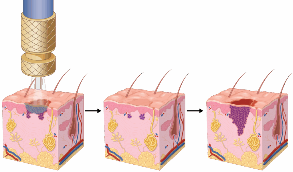 | Skintel Diagram demonstrating inappropriate use of cryotherapy/liquid nitrogen.