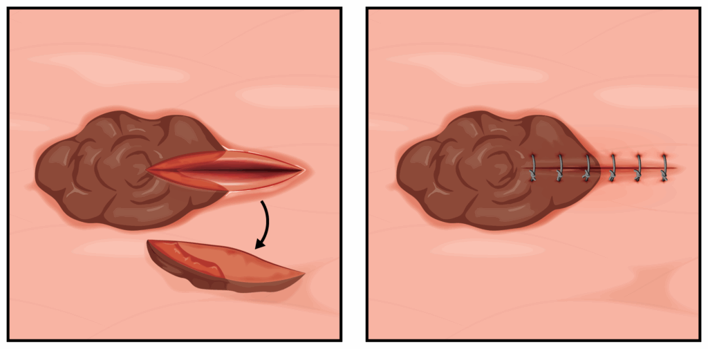 104-feat-sq | Skintel Diagram of an incisional skin biopsy.