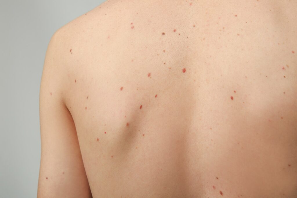 NeedleHolderCtn | Skintel Photo of back with numerous moles (naevi)